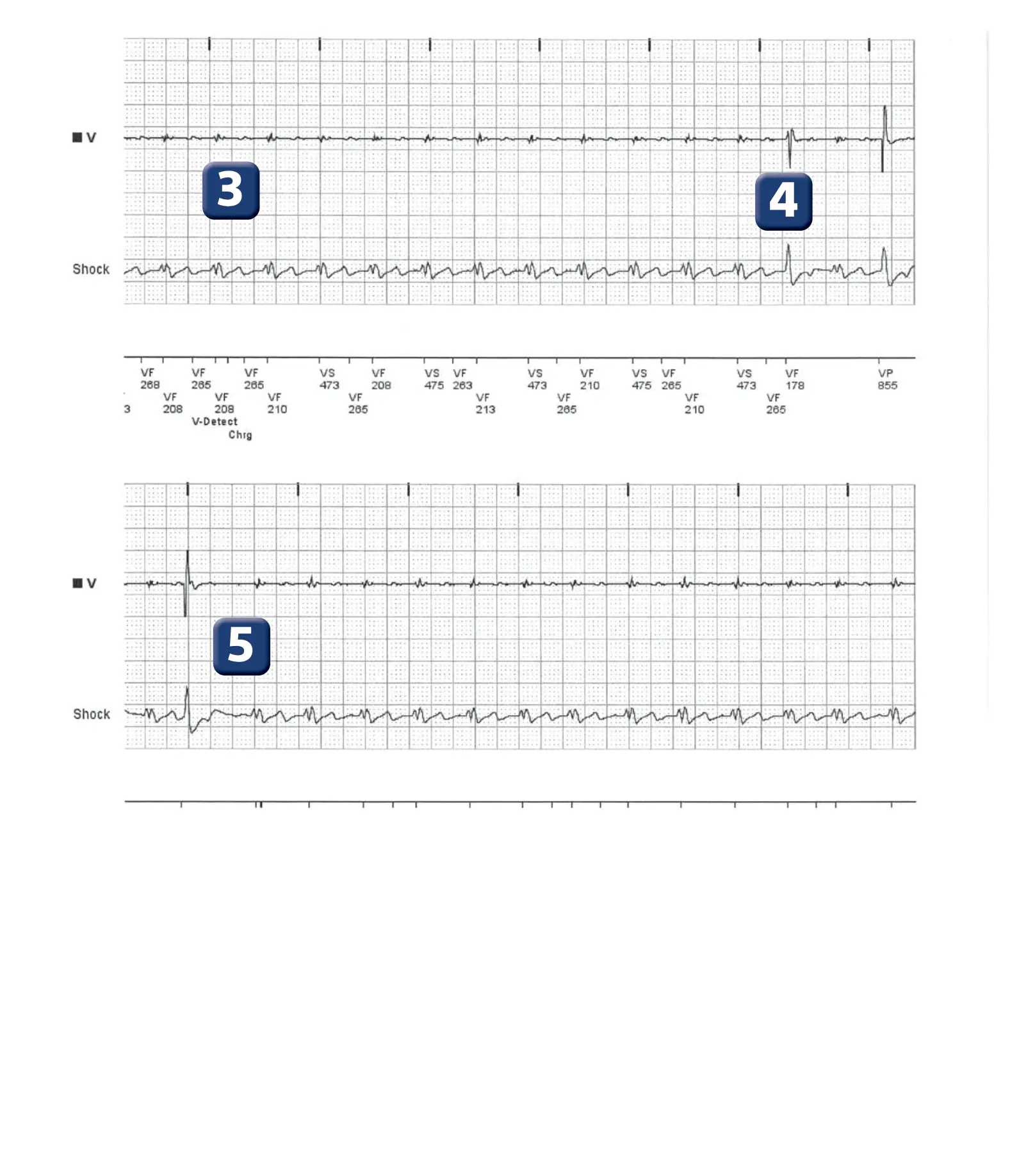 Électrogramme Boston Scientific DAI, segment 2 sur 5 — Surdétection de l’onde T