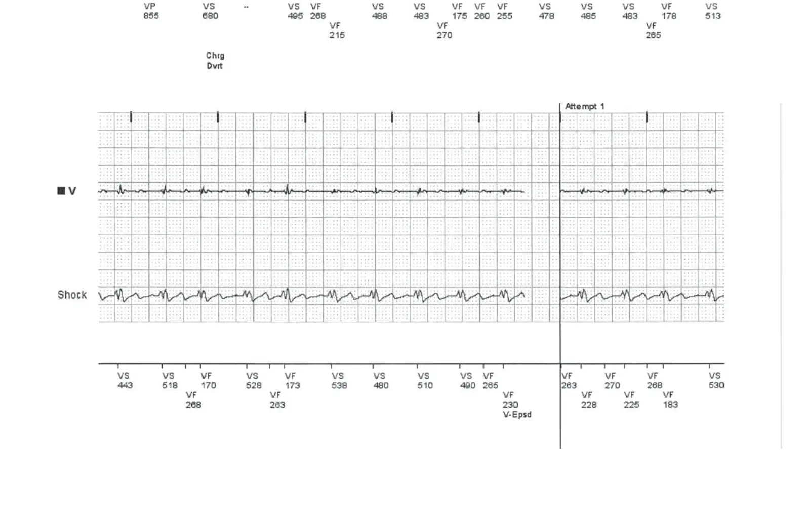 Électrogramme Boston Scientific DAI, segment 3 sur 5 — Surdétection de l’onde T