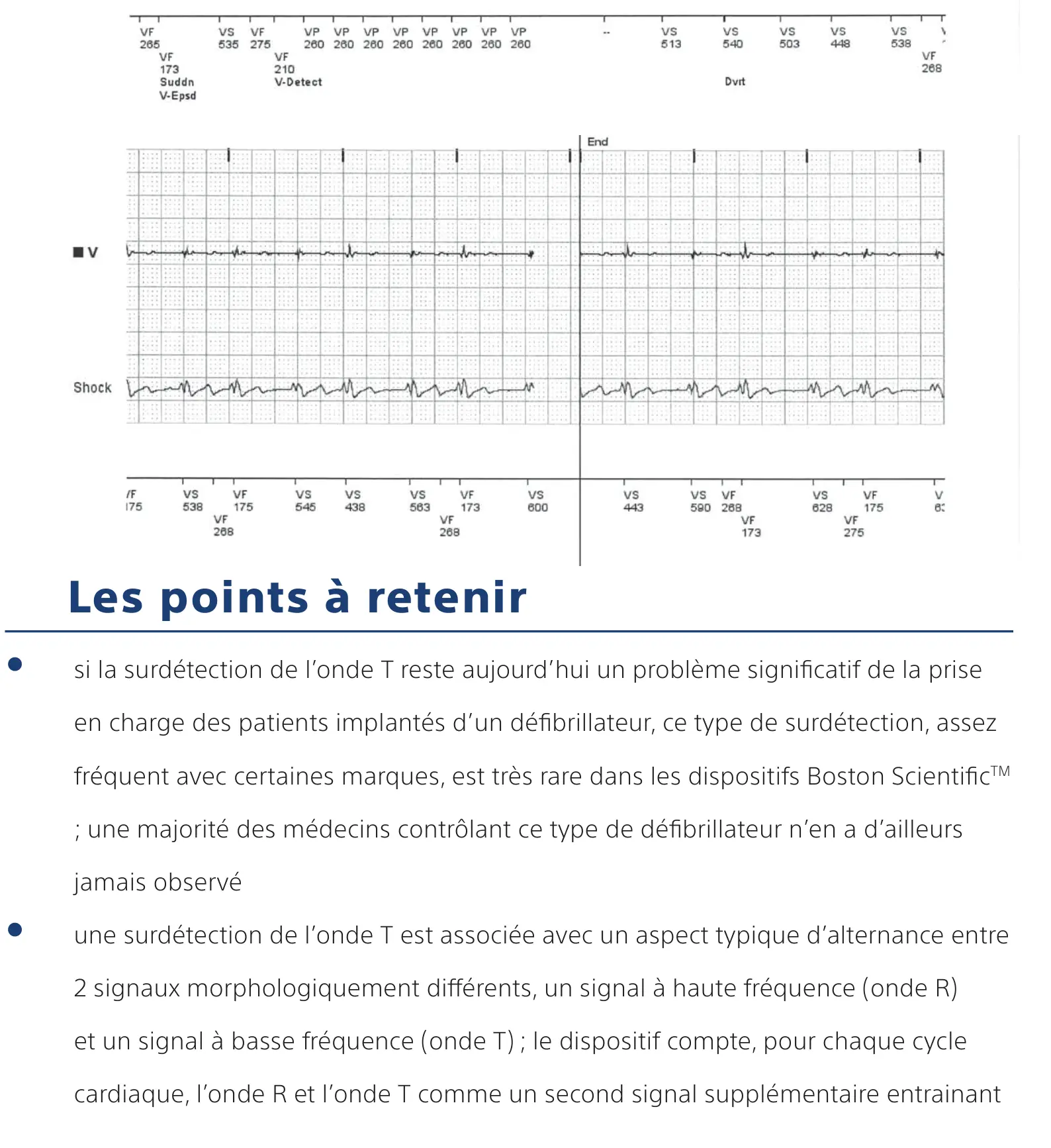 Électrogramme Boston Scientific DAI, segment 5 sur 5 — Surdétection de l’onde T