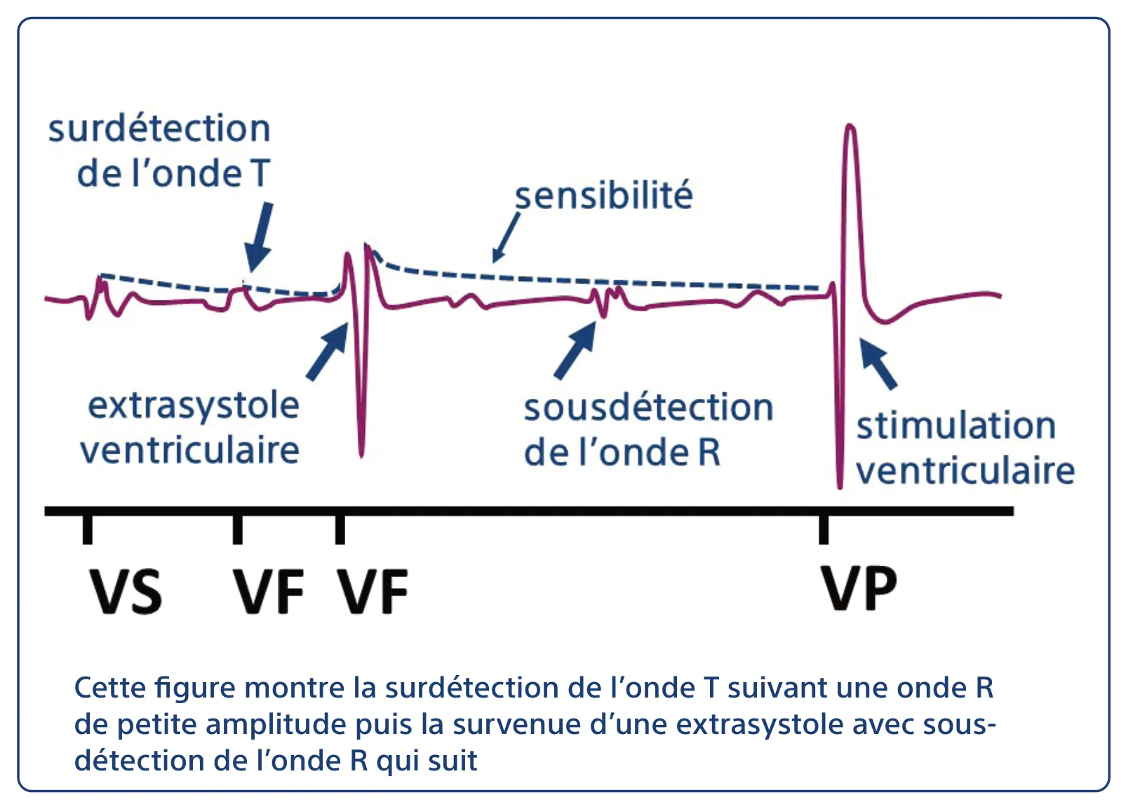 Cette figure montre la surdétection de l’onde T suivant une onde R de petite amplitude puis la survenue d’une extrasystole avec sous-détection de l’onde R qui suit