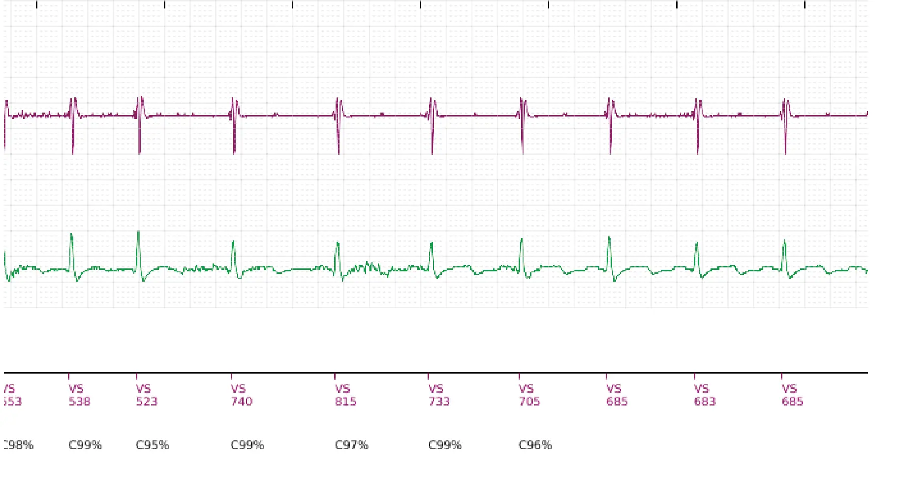 Électrogramme Boston Scientific DAI, segment 2 sur 2 — Surdétection de myopotentiels diaphragmatiques