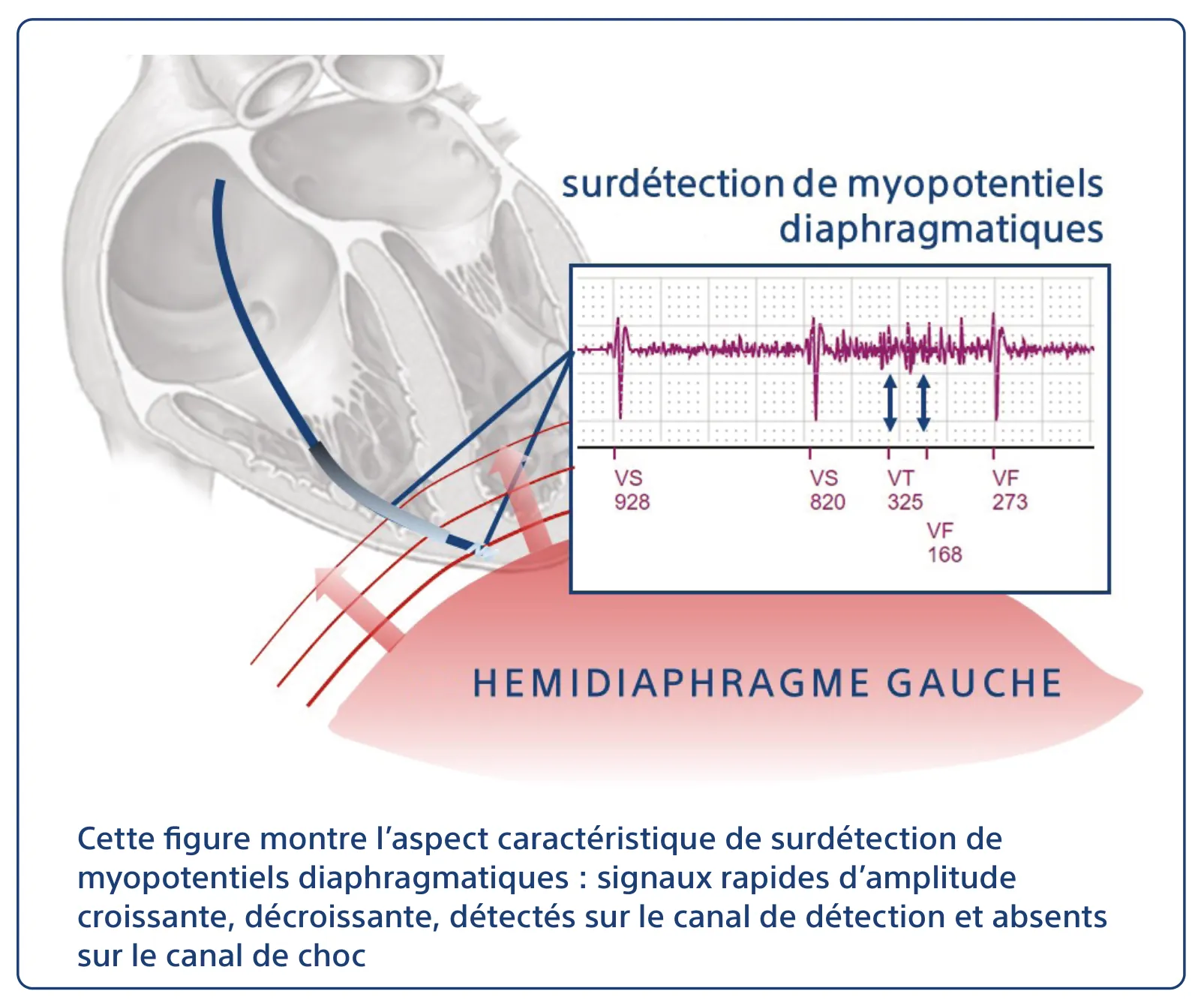 Cette figure montre l’aspect caractéristique de surdétection de myopotentiels diaphragmatiques : signaux rapides d’amplitude croissante, décroissante, détectés sur le canal de détection et absents sur le canal de choc