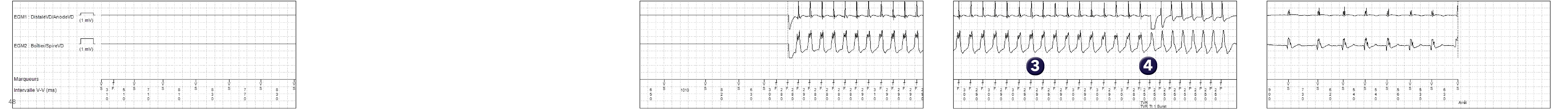 Électrogramme Medtronic DAI, segment 1 sur 1 — Spécificités du compteur de TV rapide
