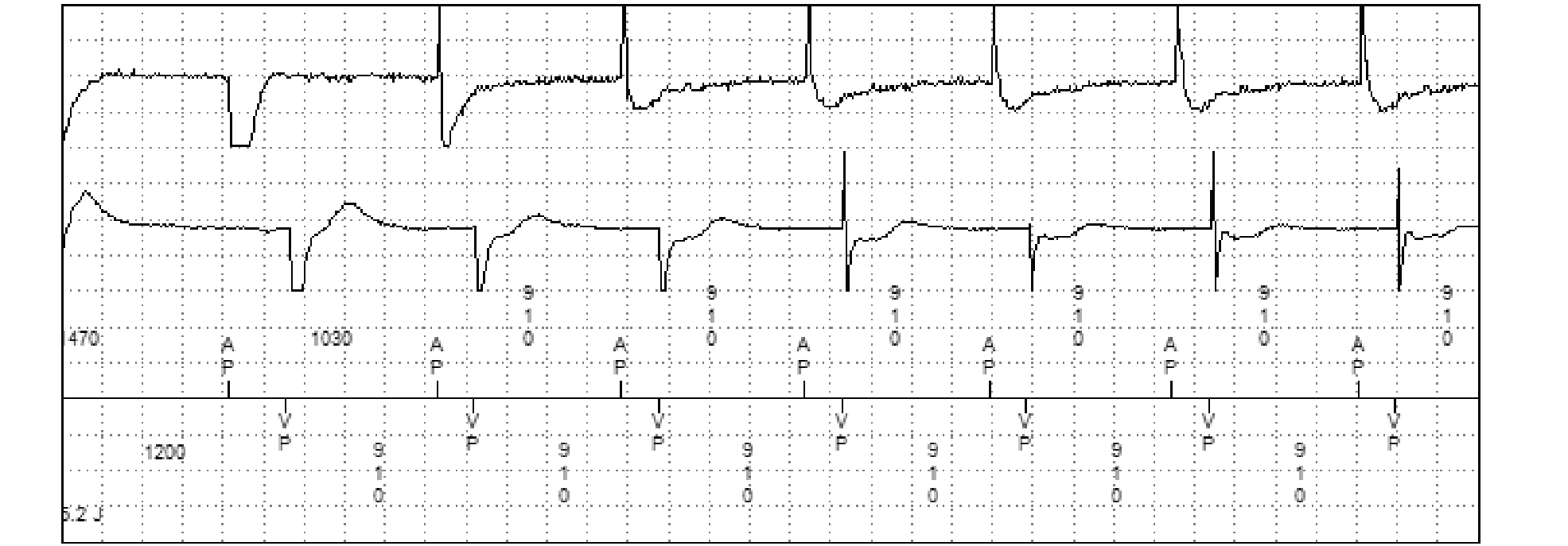 Électrogramme Medtronic DAI, segment 2 sur 2 — Compteur initial et compteur de redétection