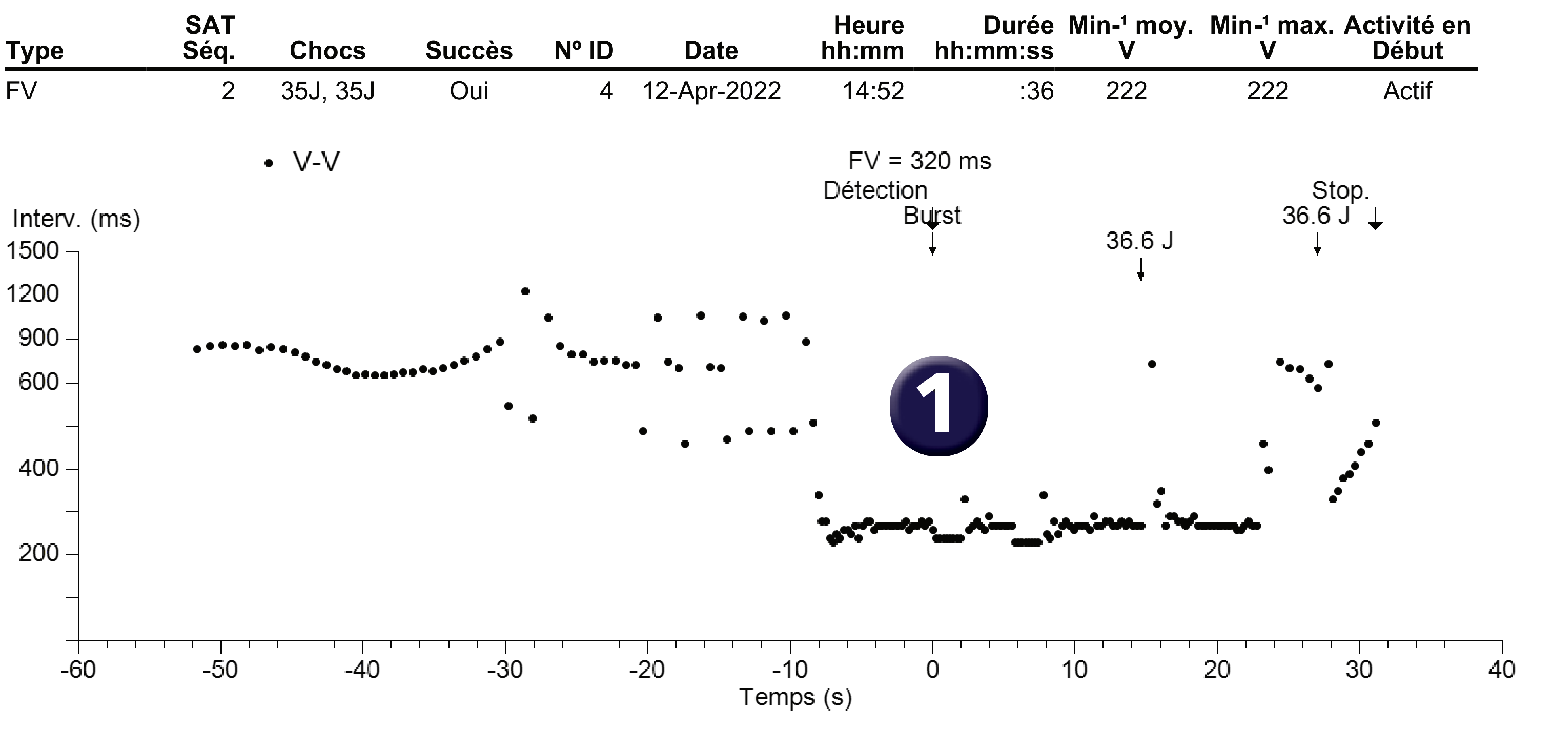 Électrogramme Medtronic DAI, segment 1 sur 1 — Absence de confirmation pour un second choc