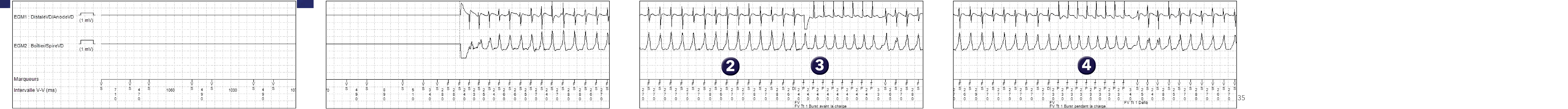 Électrogramme Medtronic DAI, segment 1 sur 2 — Absence de confirmation pour un second choc