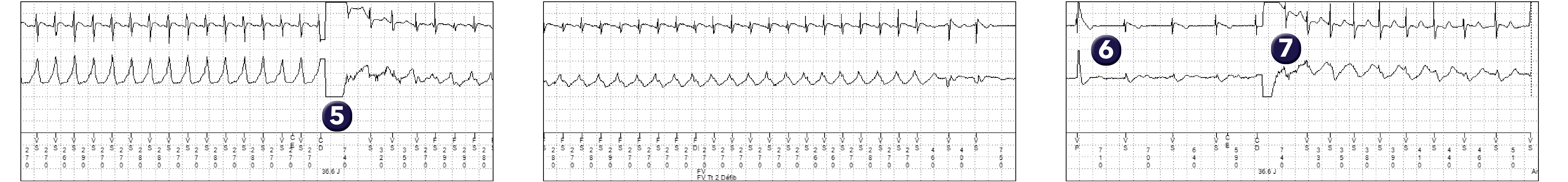 Électrogramme Medtronic DAI, segment 2 sur 2 — Absence de confirmation pour un second choc