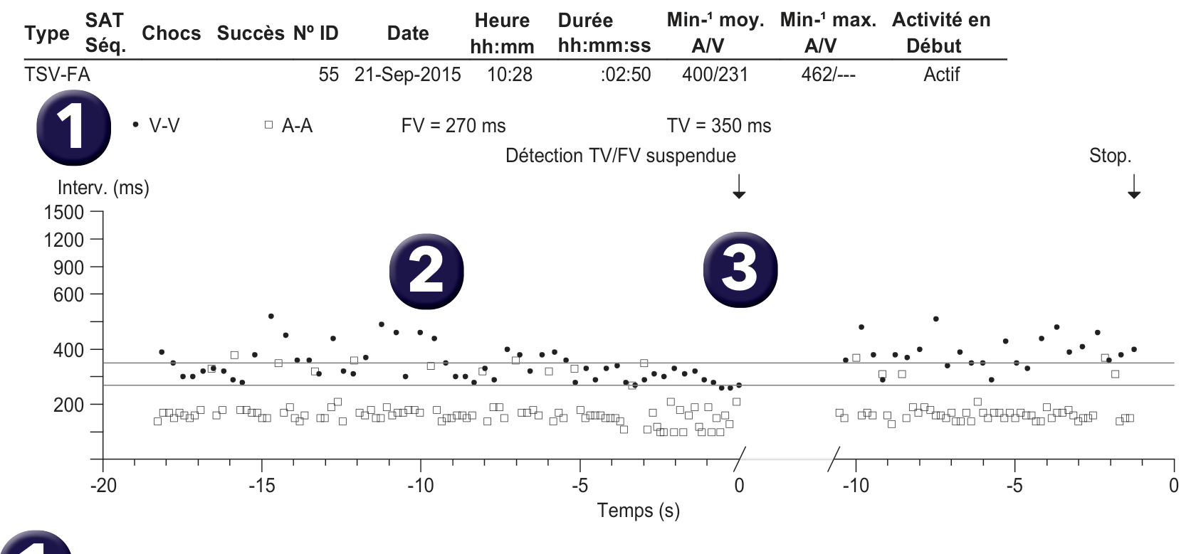 Électrogramme Medtronic DAI, segment 1 sur 1 — FA et compteur de TV