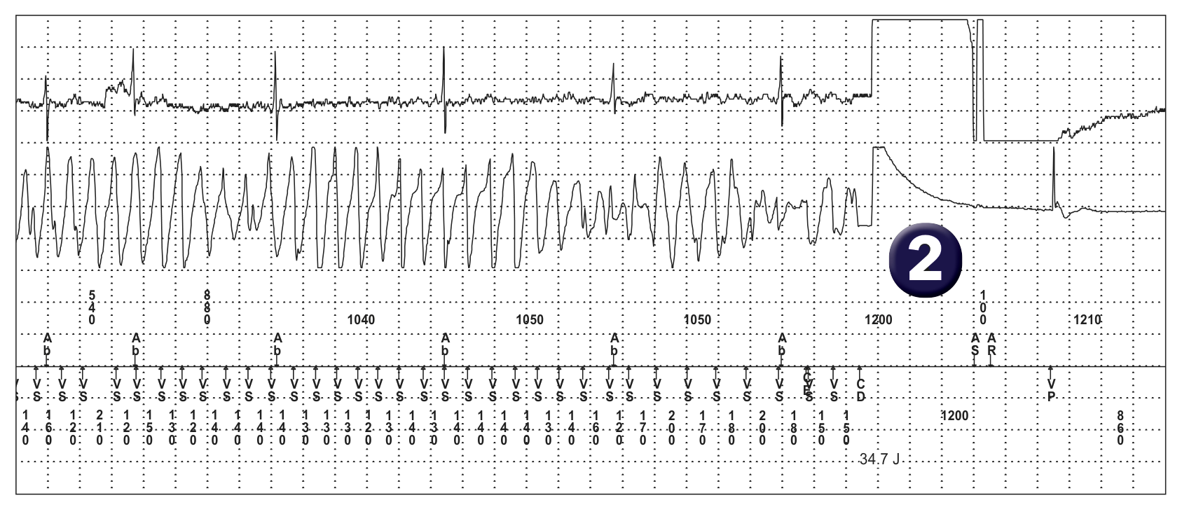 Électrogramme Medtronic DAI, segment 1 sur 1 — Effet pro-arythmogène d’un choc électrique de faible amplitude