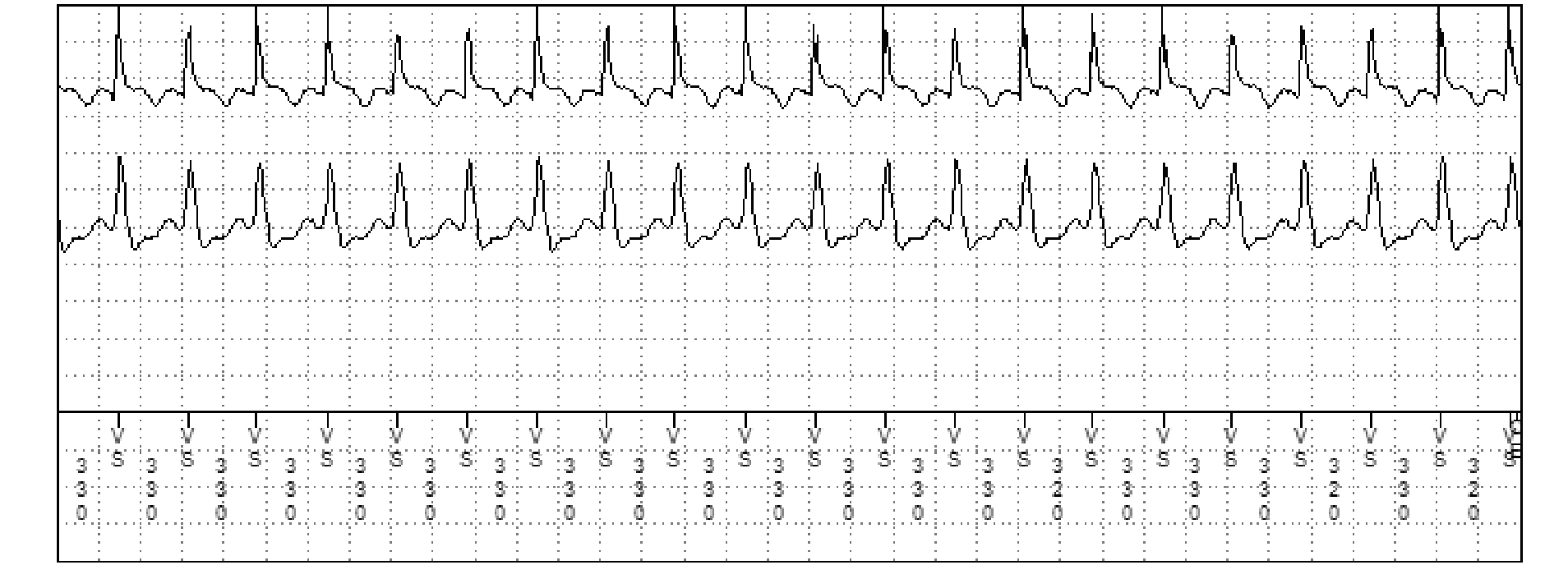 Électrogramme Medtronic DAI, segment 3 sur 3 — Programmation d’un premier choc d’amplitude maximale en zone de TV