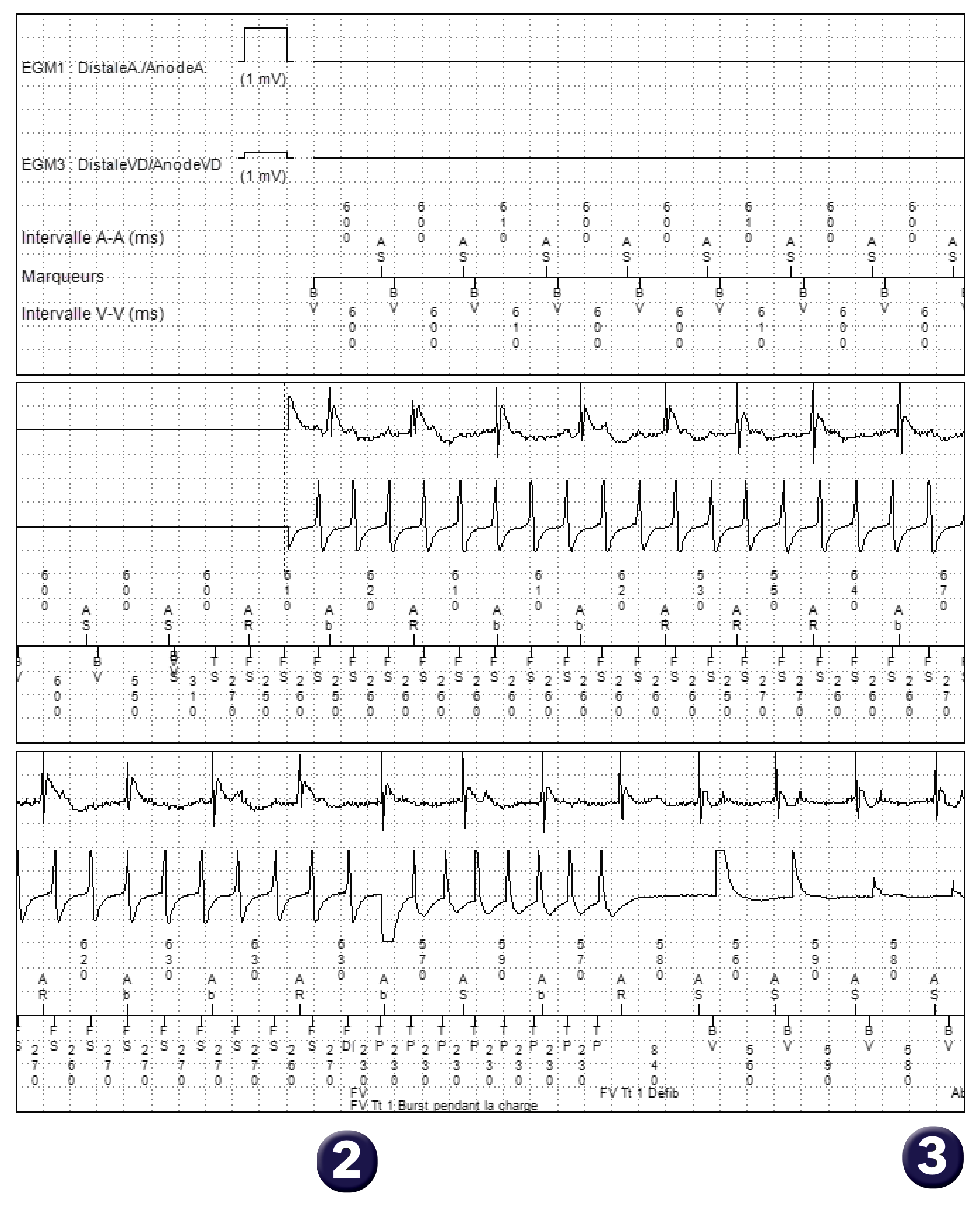 Électrogramme Medtronic DAI, segment 1 sur 4 — Stimulation anti-tachycardique en zone de FV