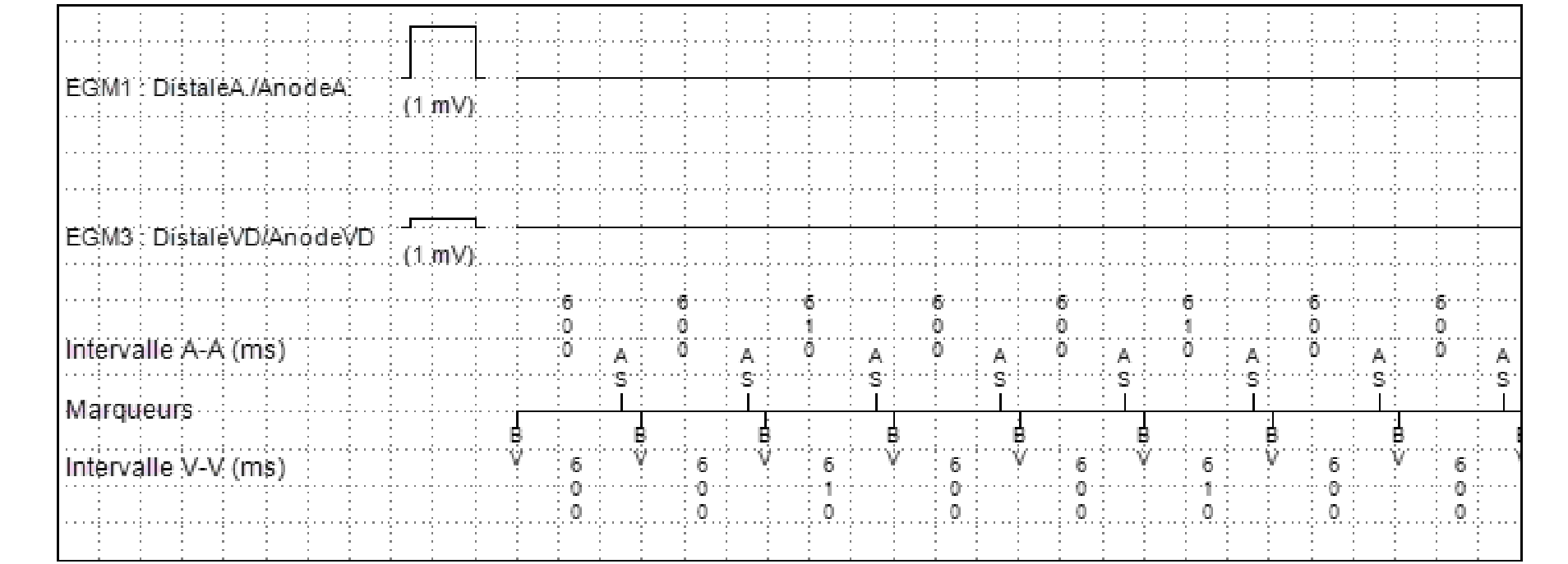 Électrogramme Medtronic DAI, segment 2 sur 4 — Stimulation anti-tachycardique en zone de FV