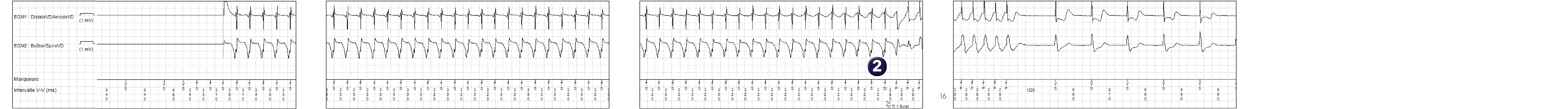 Électrogramme Medtronic DAI, segment 1 sur 1 — Stimulation anti-tachycardique en zone de TV