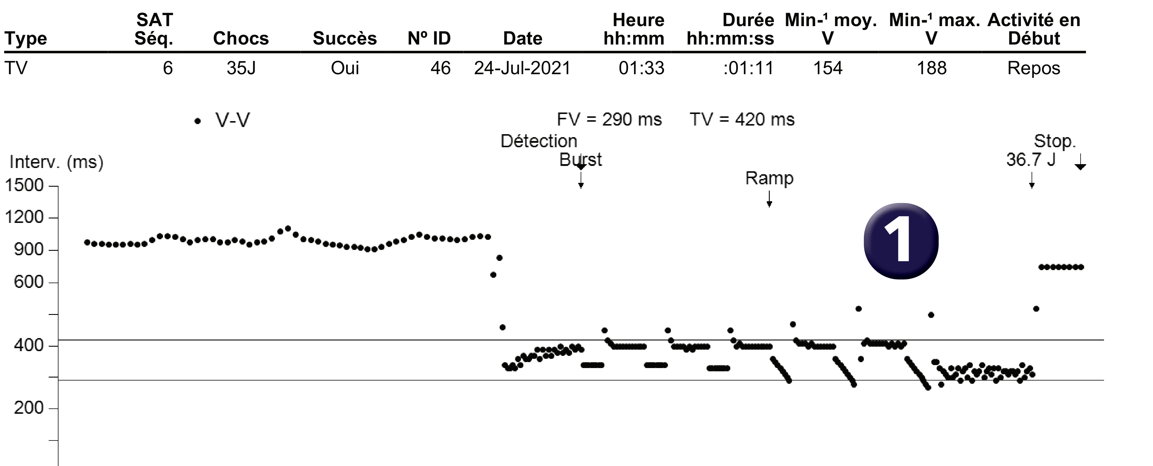 Électrogramme Medtronic DAI, segment 1 sur 1 — Accélération après plusieurs séquences de stimulation anti-tachycardique
