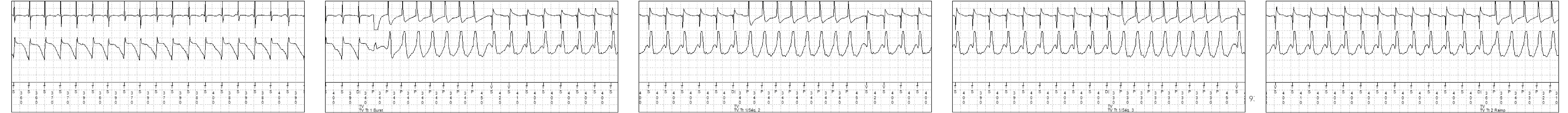 Électrogramme Medtronic DAI, segment 2 sur 3 — Accélération après plusieurs séquences de stimulation anti-tachycardique