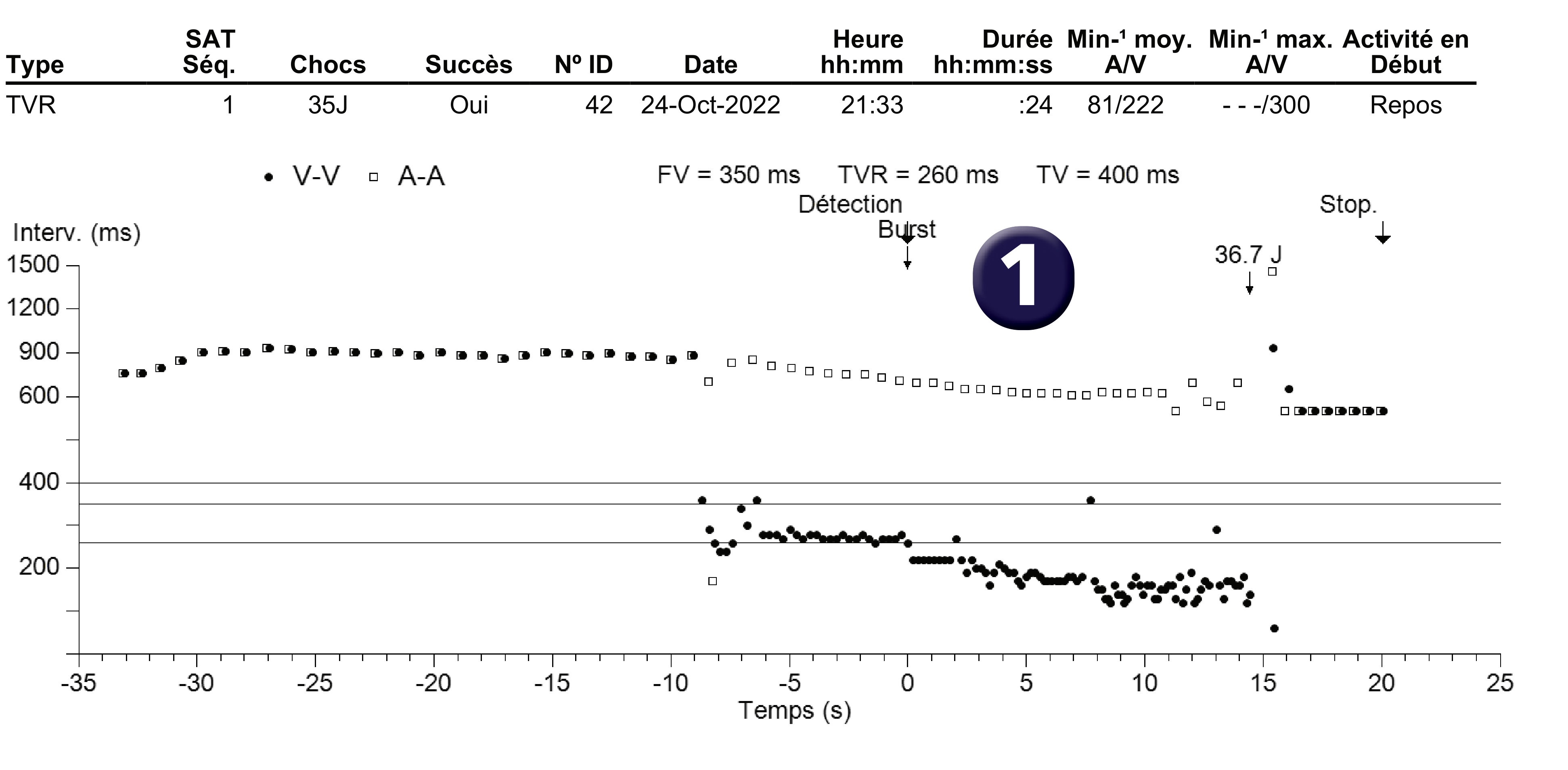 Électrogramme Medtronic DAI, segment 1 sur 1 — Accélération après stimulation anti-tachycardique