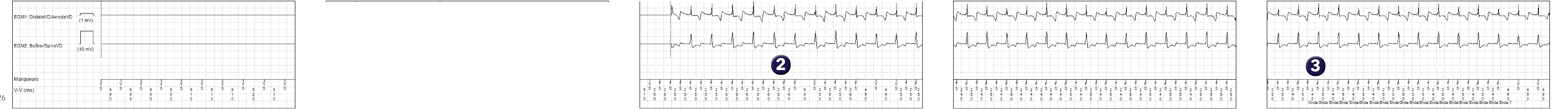 Électrogramme Medtronic DAI, segment 1 sur 2 — Intervention d’un algorithme spécifique