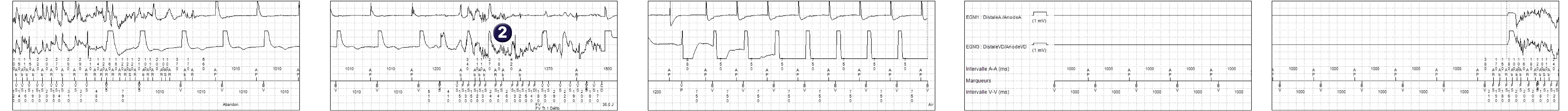 Électrogramme Medtronic DAI, segment 1 sur 2 — Choc électrique lors d’une intervention chirurgicale