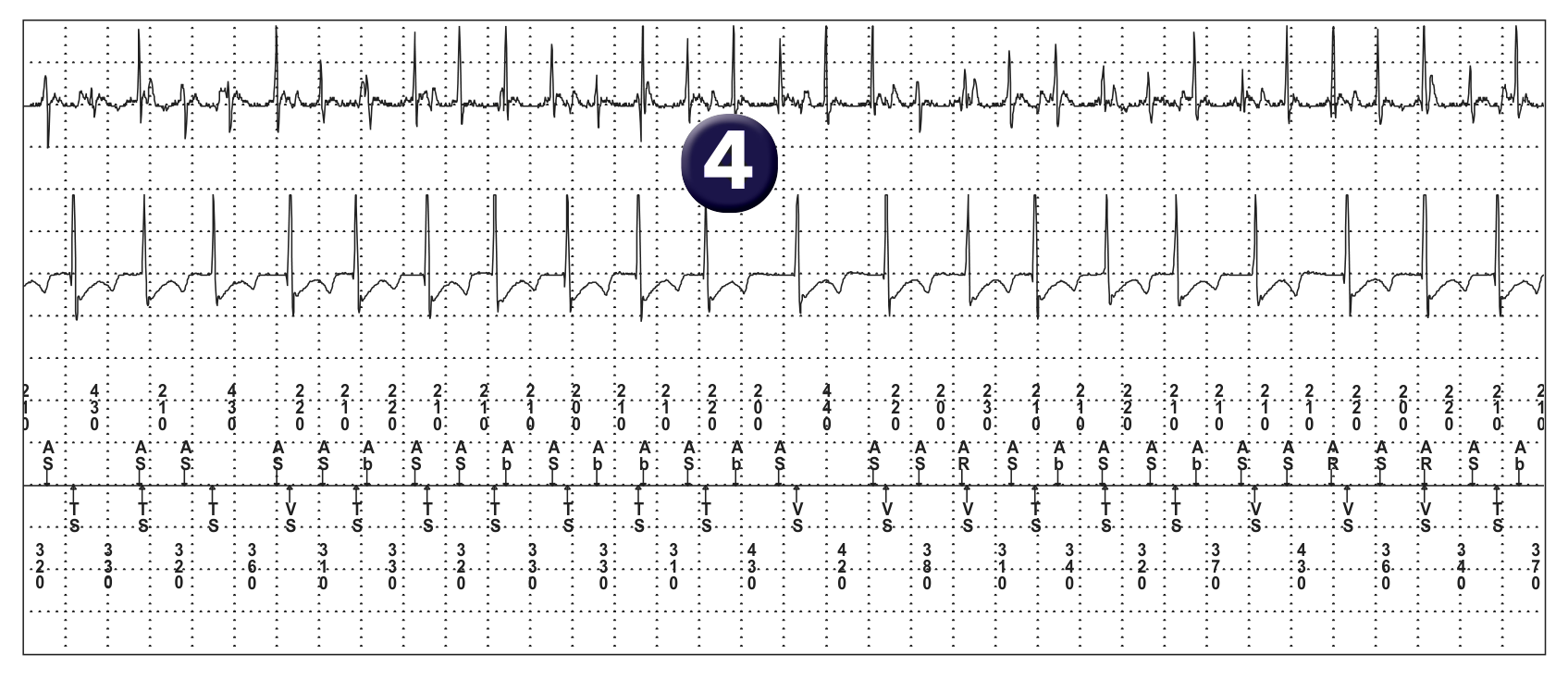 Électrogramme Medtronic DAI, segment 2 sur 6 — Discrimination double chambre et détection atriale