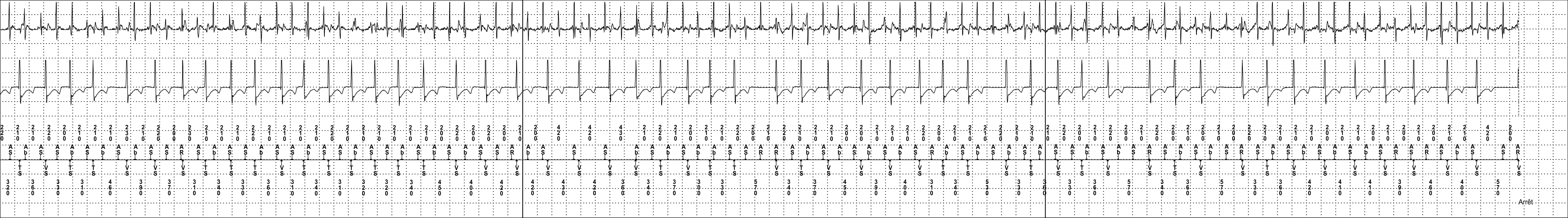 Électrogramme Medtronic DAI, segment 6 sur 6 — Discrimination double chambre et détection atriale