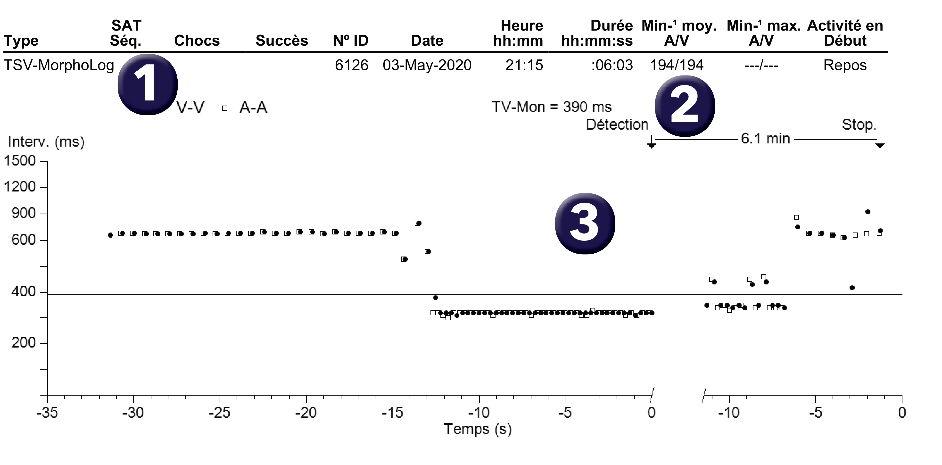 Électrogramme Medtronic DAI, segment 1 sur 2 — Tachycardie 1/1, PR Logic, MorphoLog