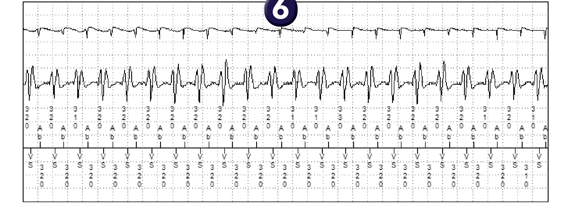 Électrogramme Medtronic DAI, segment 2 sur 2 — Tachycardie 1/1, PR Logic, MorphoLog