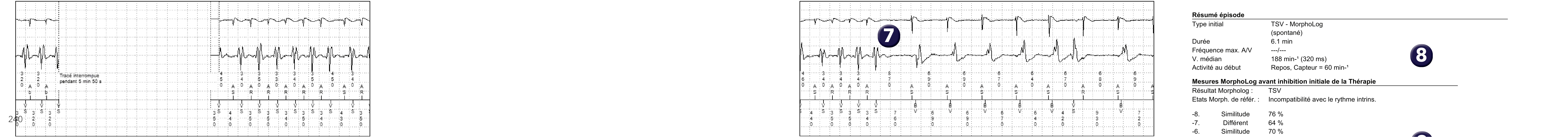 Électrogramme Medtronic DAI, segment 2 sur 2 — Tachycardie 1/1, PR Logic, MorphoLog