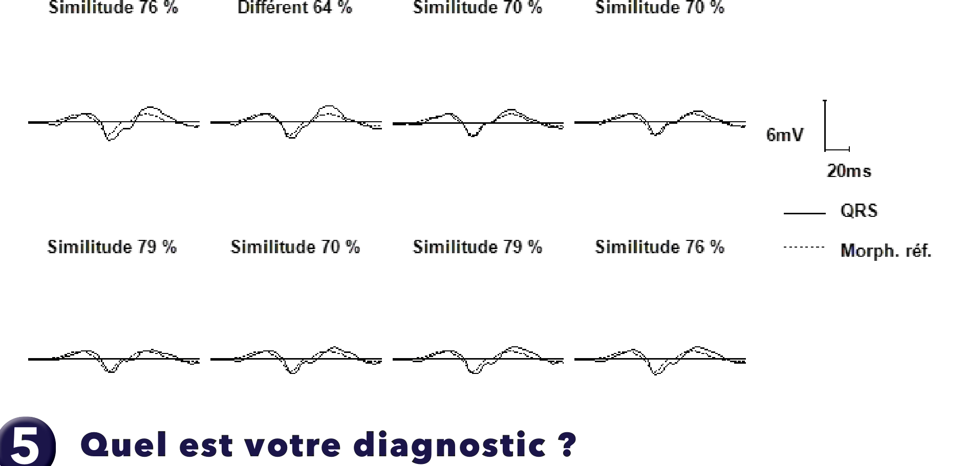 Électrogramme Medtronic DAI, segment 3 sur 3 — PR Logic et FA conduite