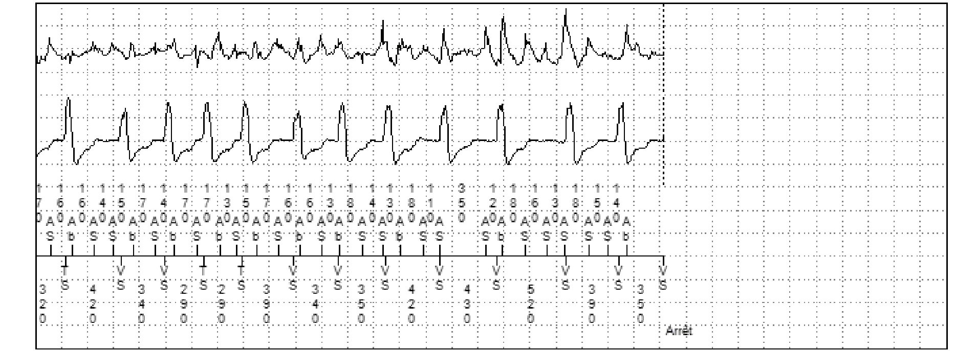 Électrogramme Medtronic DAI, segment 2 sur 2 — FA conduite, PR Logic et MorphoLog
