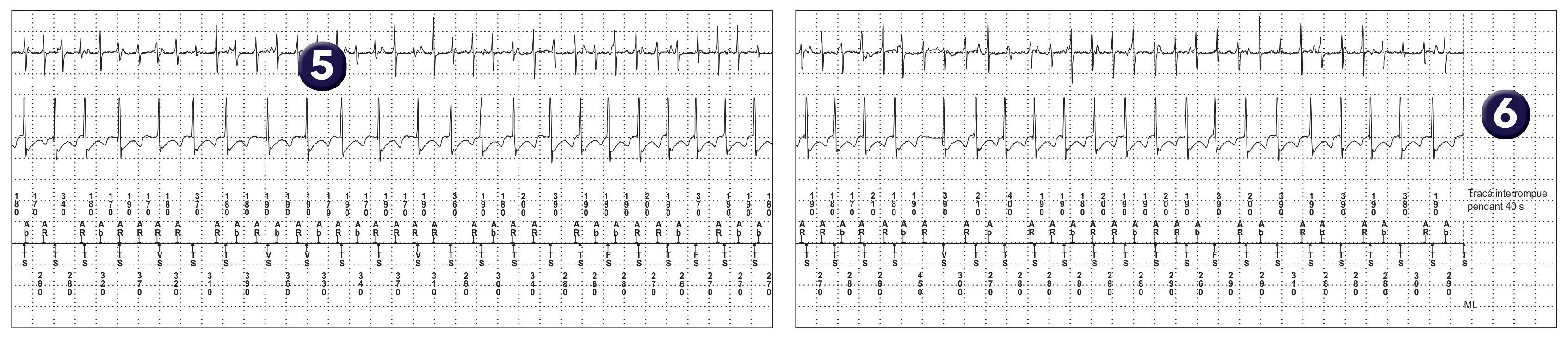 Électrogramme Medtronic DAI, segment 1 sur 1 — FA régularisée, PR Logic et MorphoLog
