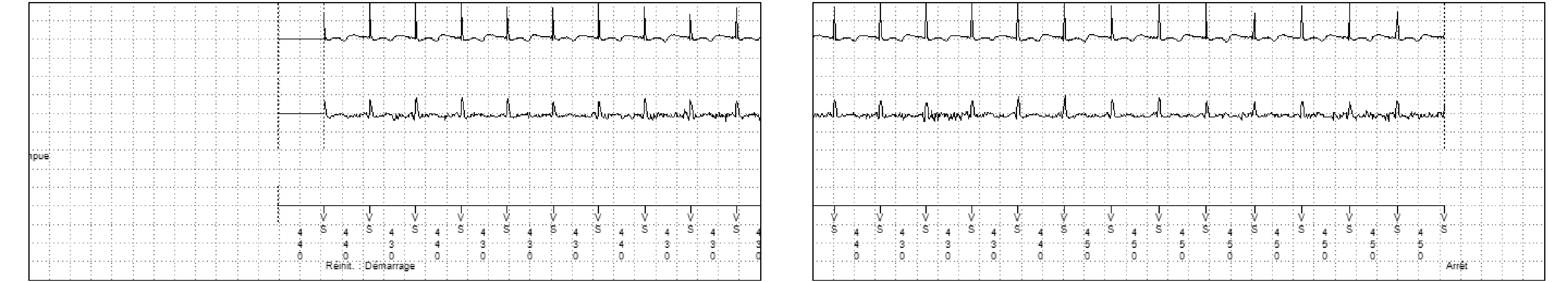Électrogramme Medtronic DAI, segment 2 sur 2 — Démarrage brutal et tachycardie sinusale