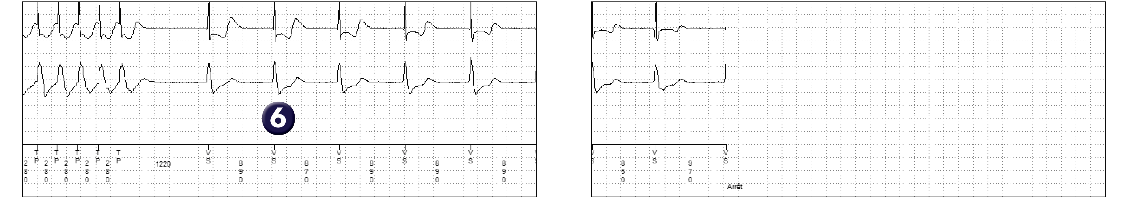 Électrogramme Medtronic DAI, segment 2 sur 2 — Choix des critères de discrimination dans un défibrillateur simple chambre