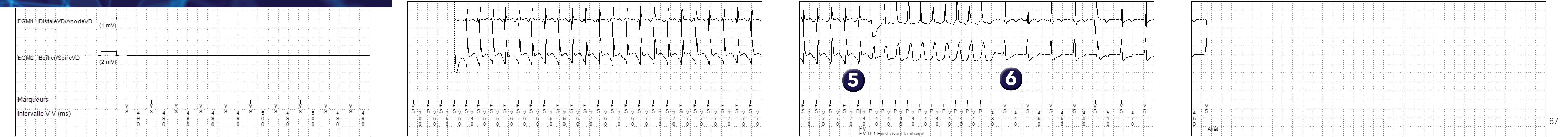 Électrogramme Medtronic DAI, segment 1 sur 1 — Défibrillateur simple chambre et nouvelles recommandations