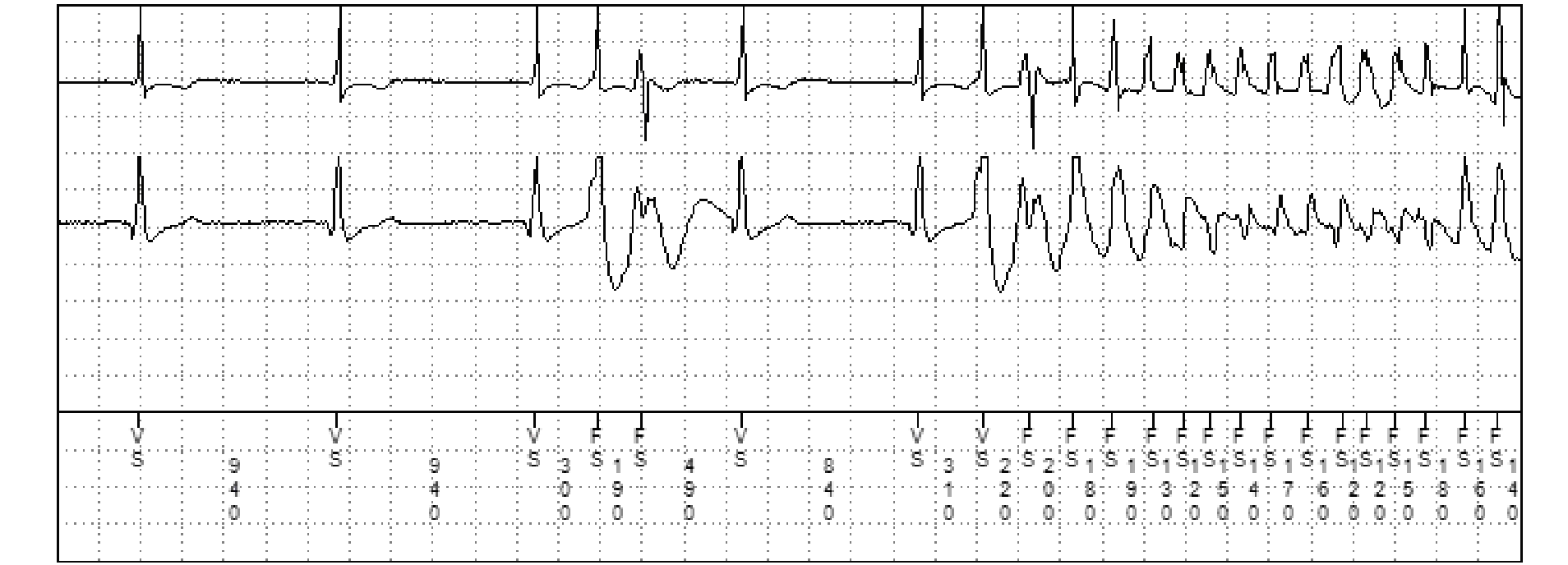 Électrogramme Medtronic DAI, segment 2 sur 2 — Défibrillateur simple chambre et limite V.TSV