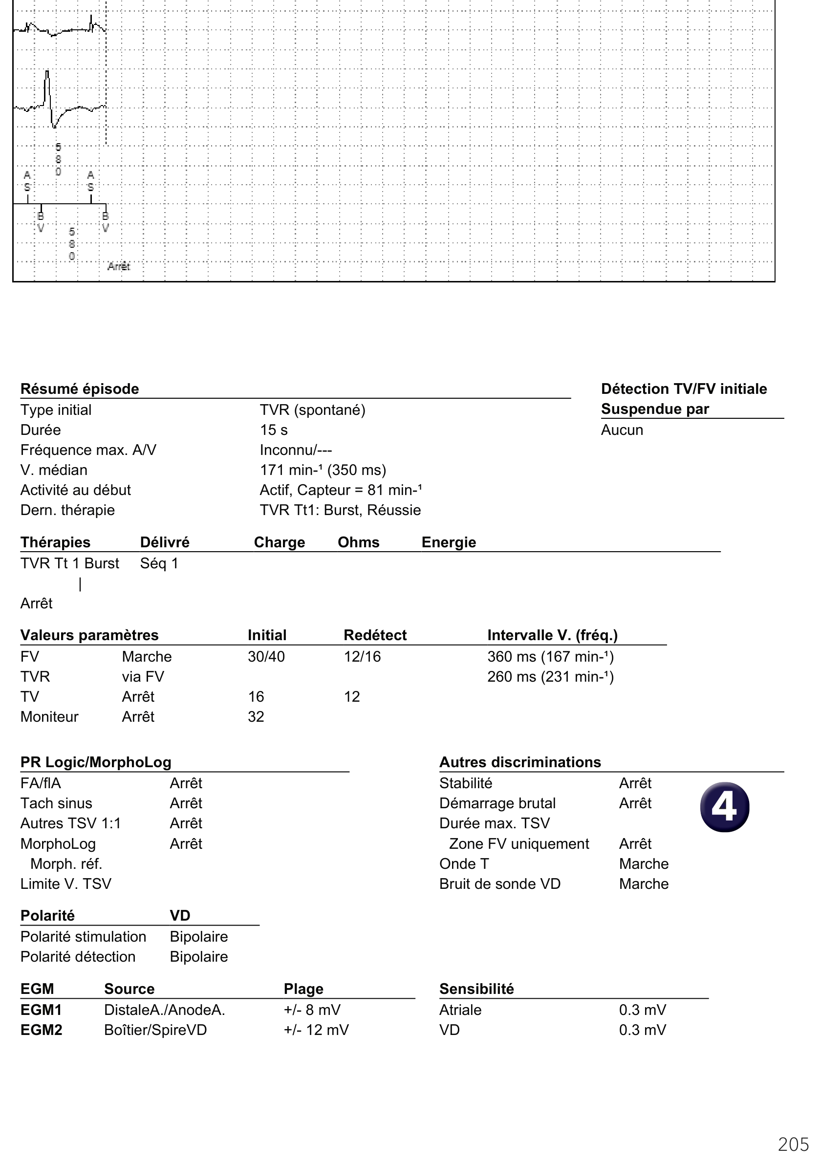 Électrogramme Medtronic DAI, segment 1 sur 1 — Discrimination et troubles de la conduction auriculo-ventriculaire