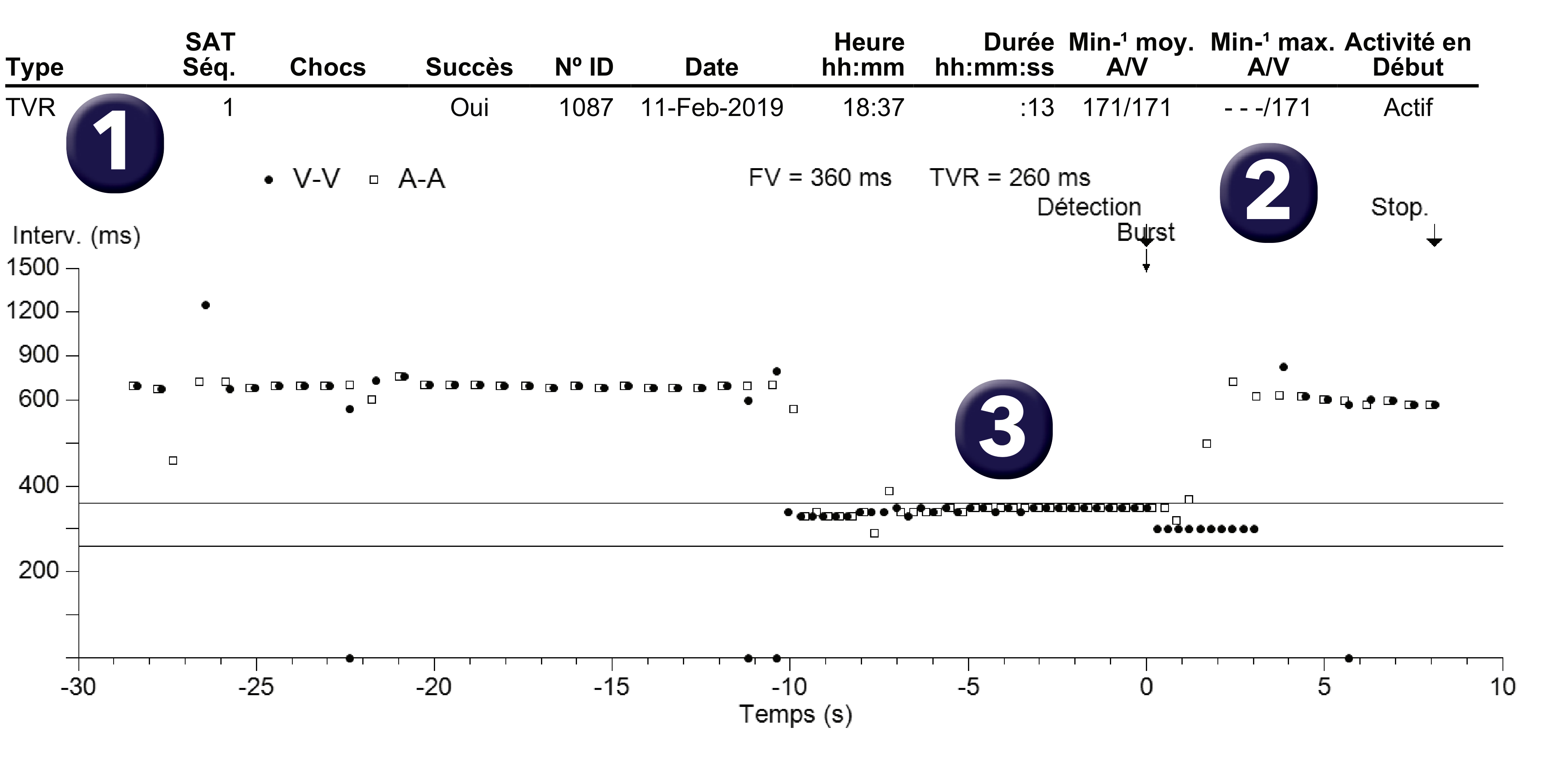 Électrogramme Medtronic DAI, segment 1 sur 1 — Discrimination et troubles de la conduction