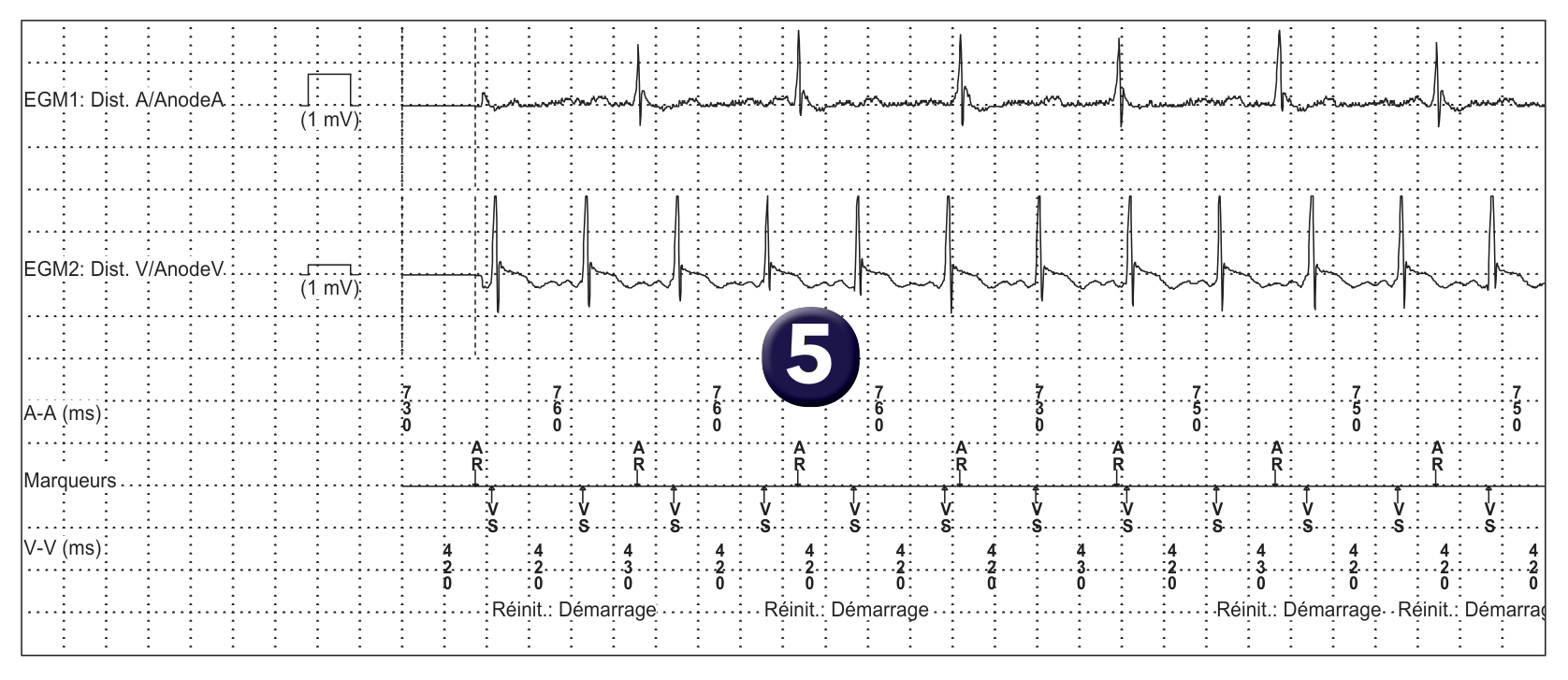 Électrogramme Medtronic DAI, segment 1 sur 1 — Discriminant simple chambre sur un défibrillateur double chambre