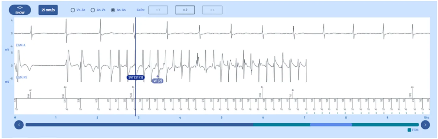 MicroPort DAI, Electrogramme : fin — Compteur et diagnostic de la FV