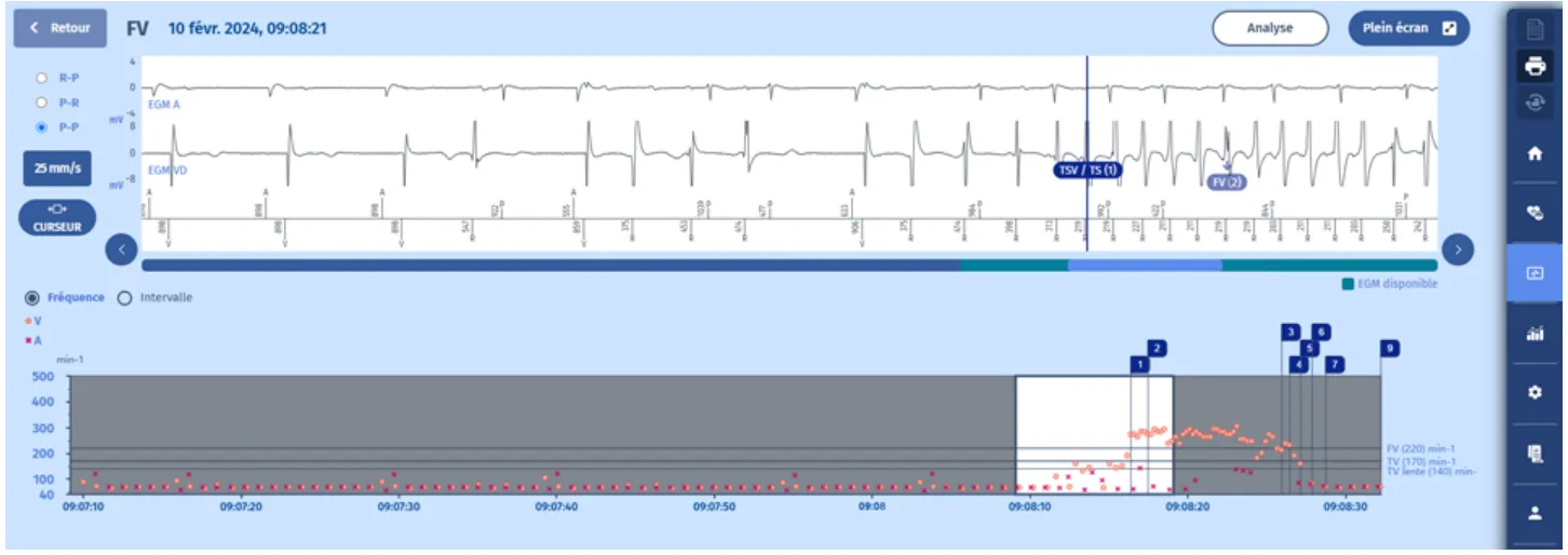 MicroPort DAI, Electrogramme — Tachycardie traitée par un choc, ou est-ce le cas ?