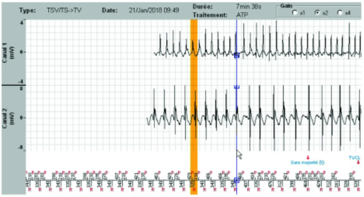MicroPort DAI, EGM — Stabilisation d’une tachycardie sur fond d’arythmie auriculaire; un diagnostic très difficile à poser