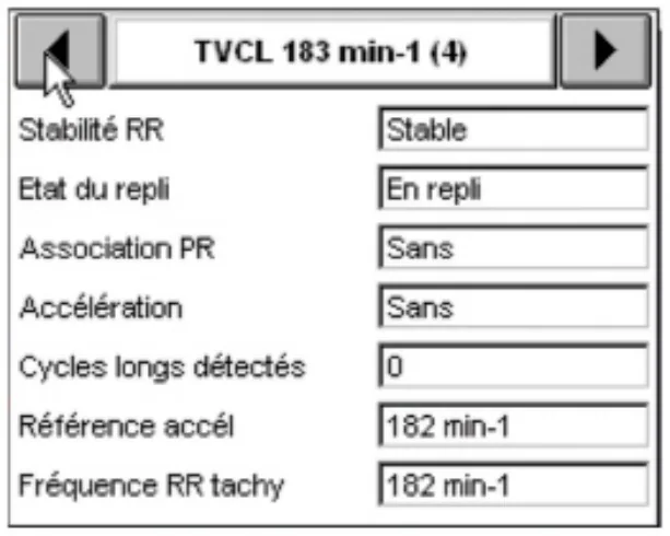 MicroPort DAI, Interprétation — Stabilisation d’une tachycardie sur fond d’arythmie auriculaire; un diagnostic très difficile à poser