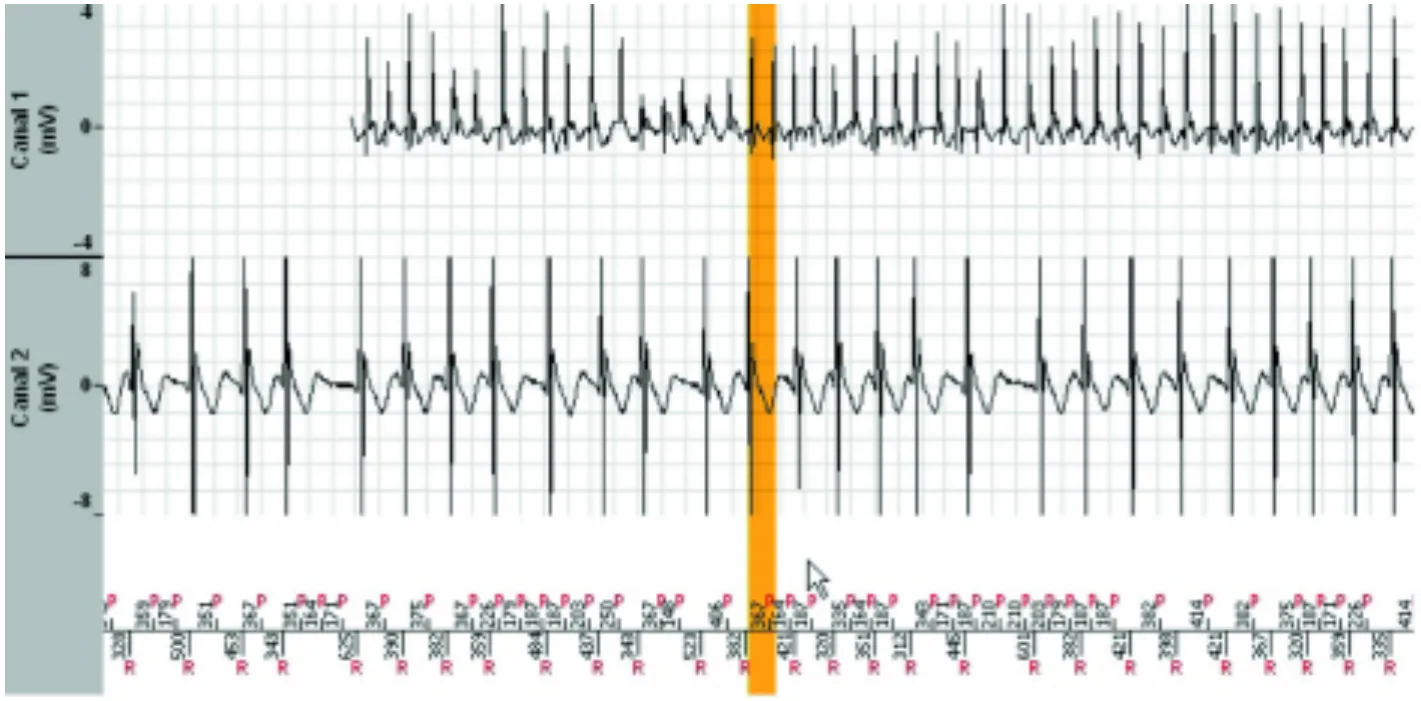 MicroPort DAI, Interprétation — Stabilisation d’une tachycardie sur fond d’arythmie auriculaire; un diagnostic très difficile à poser