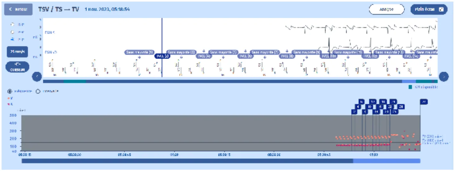 MicroPort DAI, Tachogramme — Surdétection de l’onde T