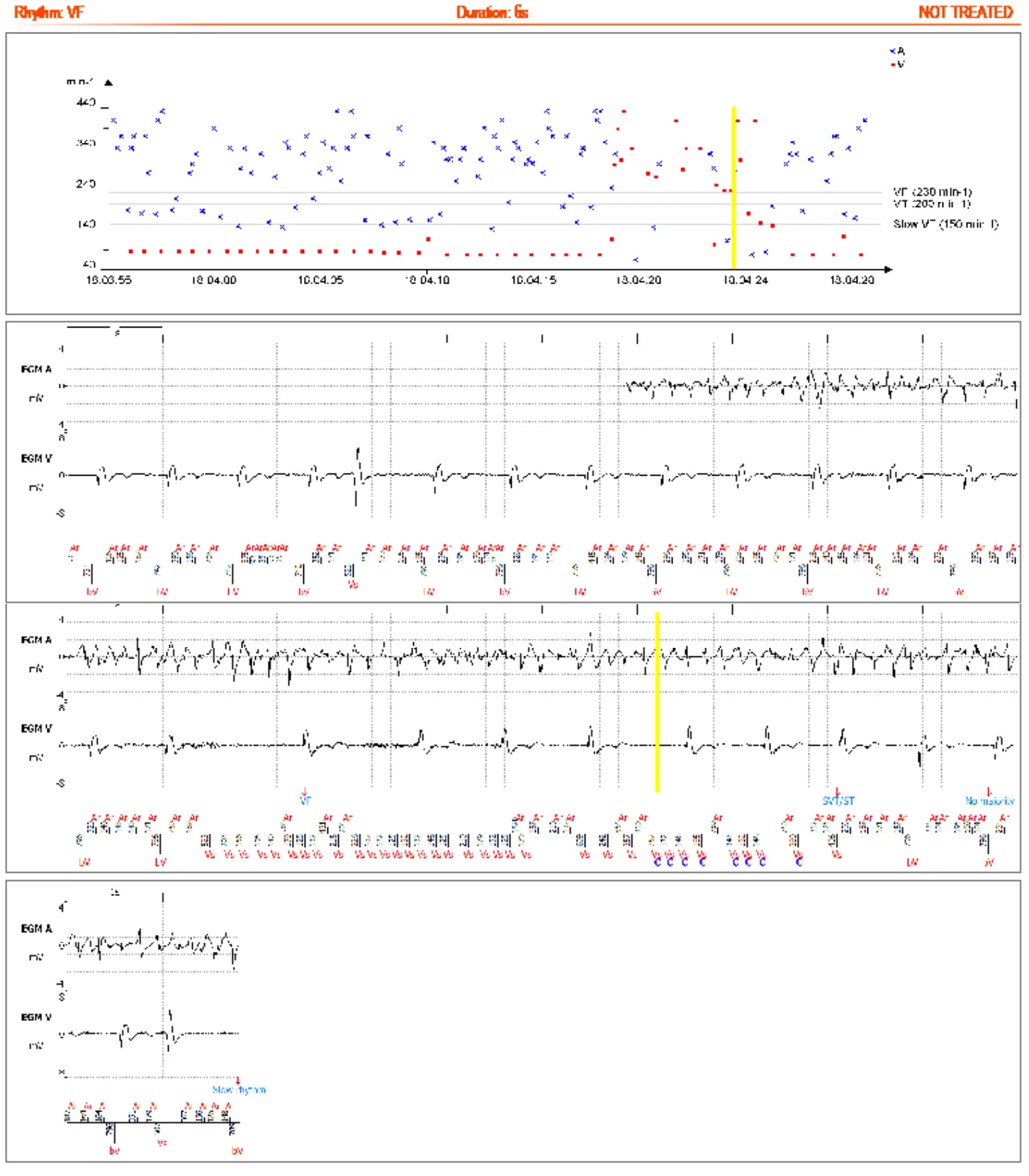 MicroPort DAI, Vous recevez la transmission suivante : — Surdétection V suspectée