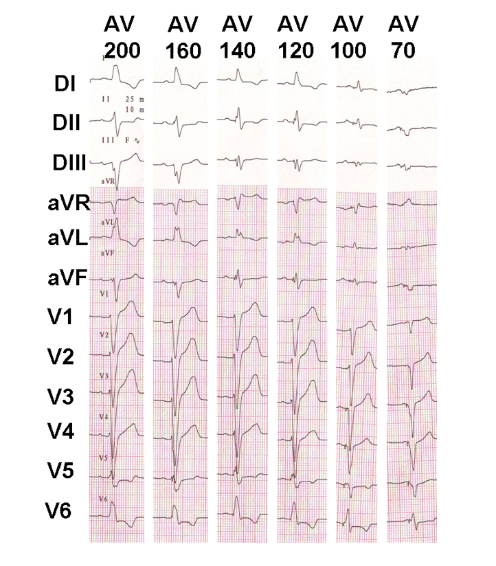 Optimization of the AV delay in a patient with complete AV block