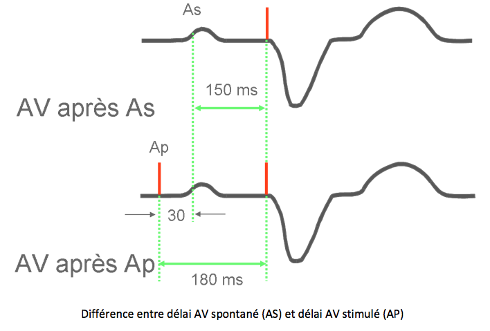 pm_19_situations_delai_atrio-ventriculaire_1.png