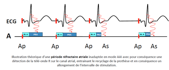 pm_19_situations_periodes_refractaires_1.png