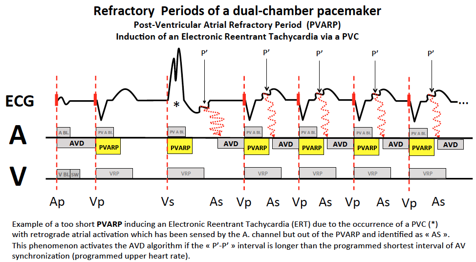 Optimization of the AV delay in a patient with complete AV block