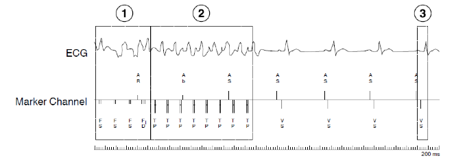 icd_in_20_atp_in_vf_zone_3.png