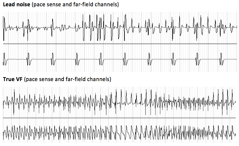 icd_in_20_cs_oversensing_1.png